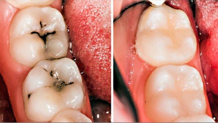Featured image of post Imagens De Cárie No Dente : Gerson feldens, eliane associação entre experiência de cárie em molares decíduos e primeiros molares permanentes.